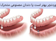 اوردنچر بهتر است یا دندان مصنوعی متحرک؟