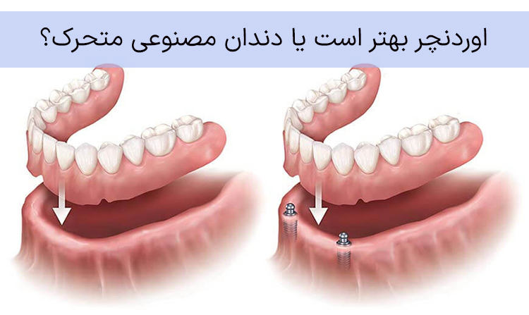 اوردنچر بهتر است یا دندان مصنوعی متحرک؟