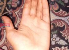 دست سوخته دخترروستایی؛ وقتی پول نیست، درمان هم نیست