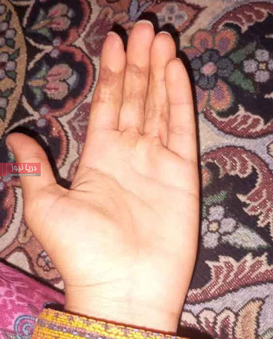 دست سوخته دخترروستایی؛ وقتی پول نیست، درمان هم نیست